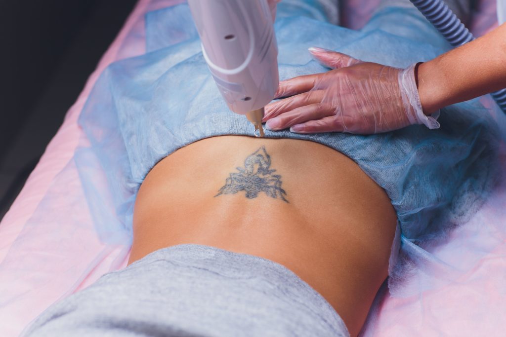 Laser tattoo removal procedure in Idaho Falls
