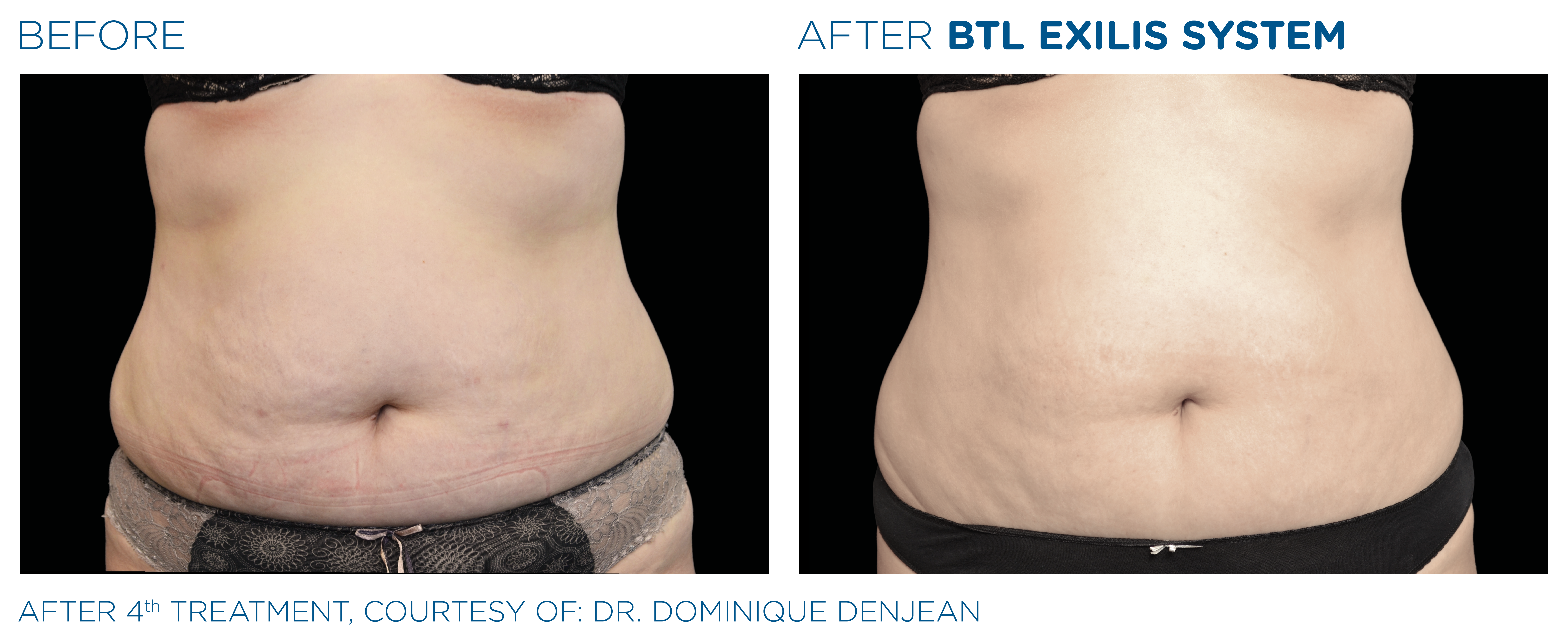 BTL_Exilis_system_PIC_Ba-card-female-abdomen-018_ENUS100_1650045286