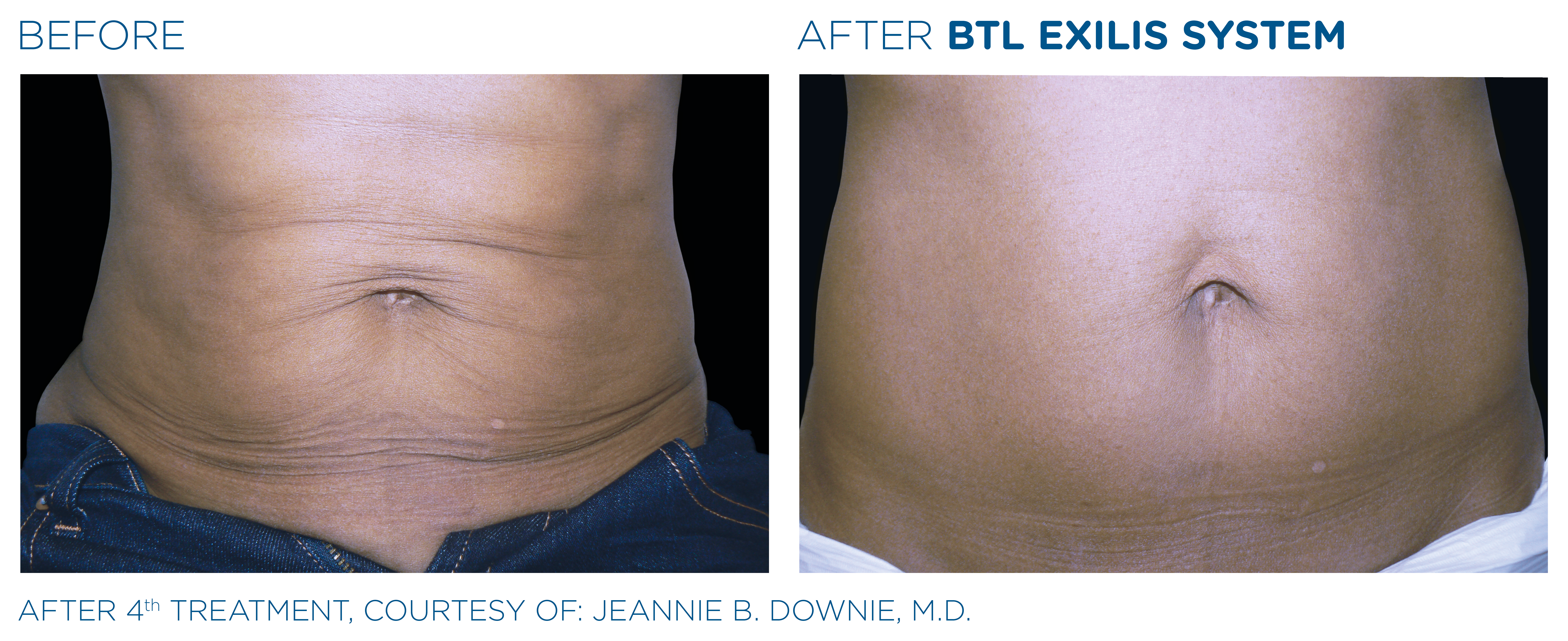 BTL_Exilis_system_PIC_Ba-card-female-abdomen-026_ENUS100_1650045332