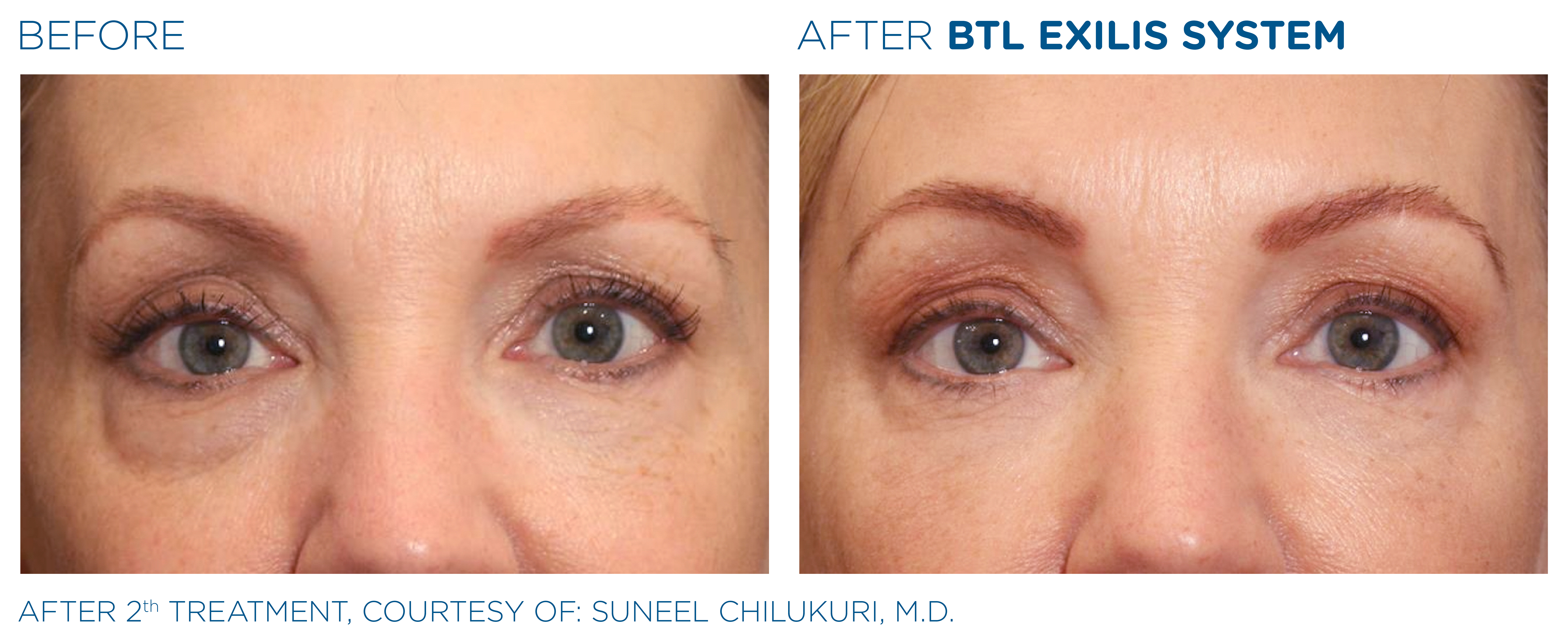 BTL_Exilis_system_PIC_Ba-card-female-eyes-015_ENUS100_1650045365