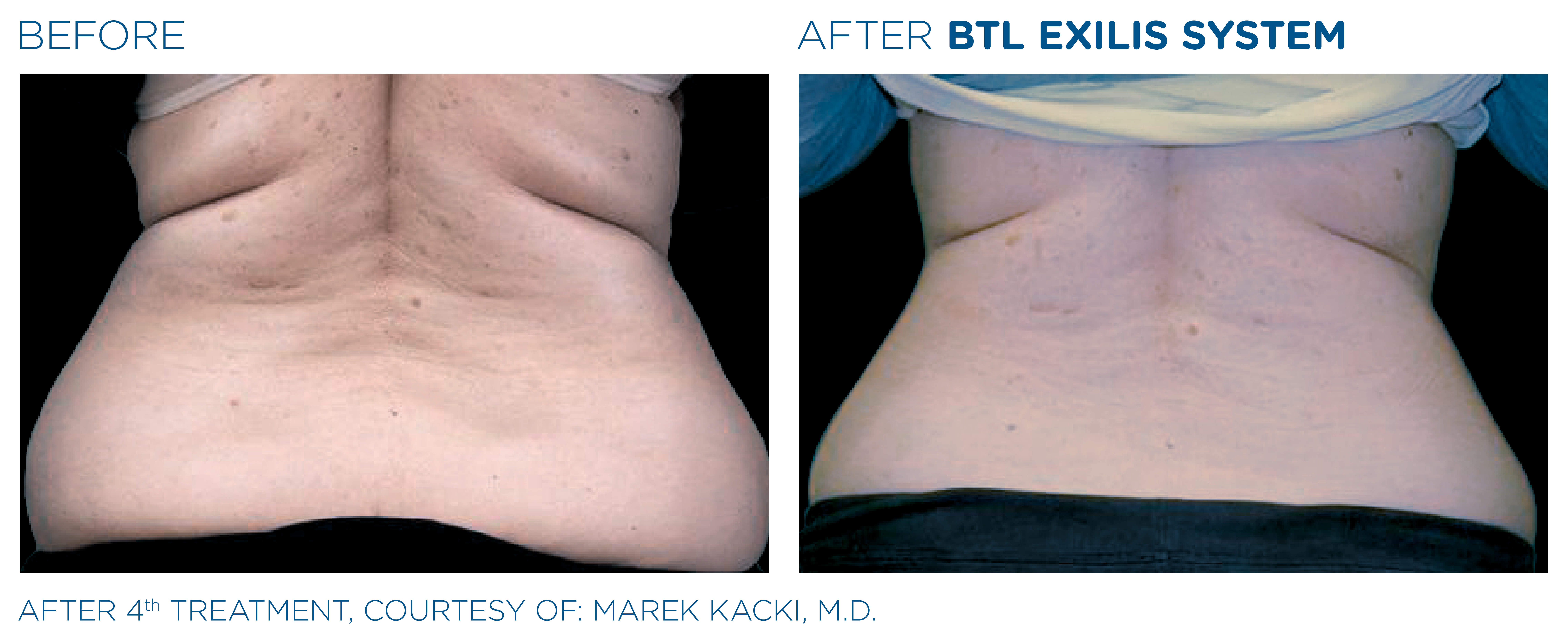 BTL_Exilis_system_PIC_Ba-card-female-love-handles-019_ENUS100_1650045437