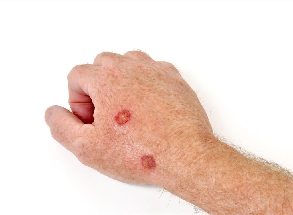 actinic keratosis horn