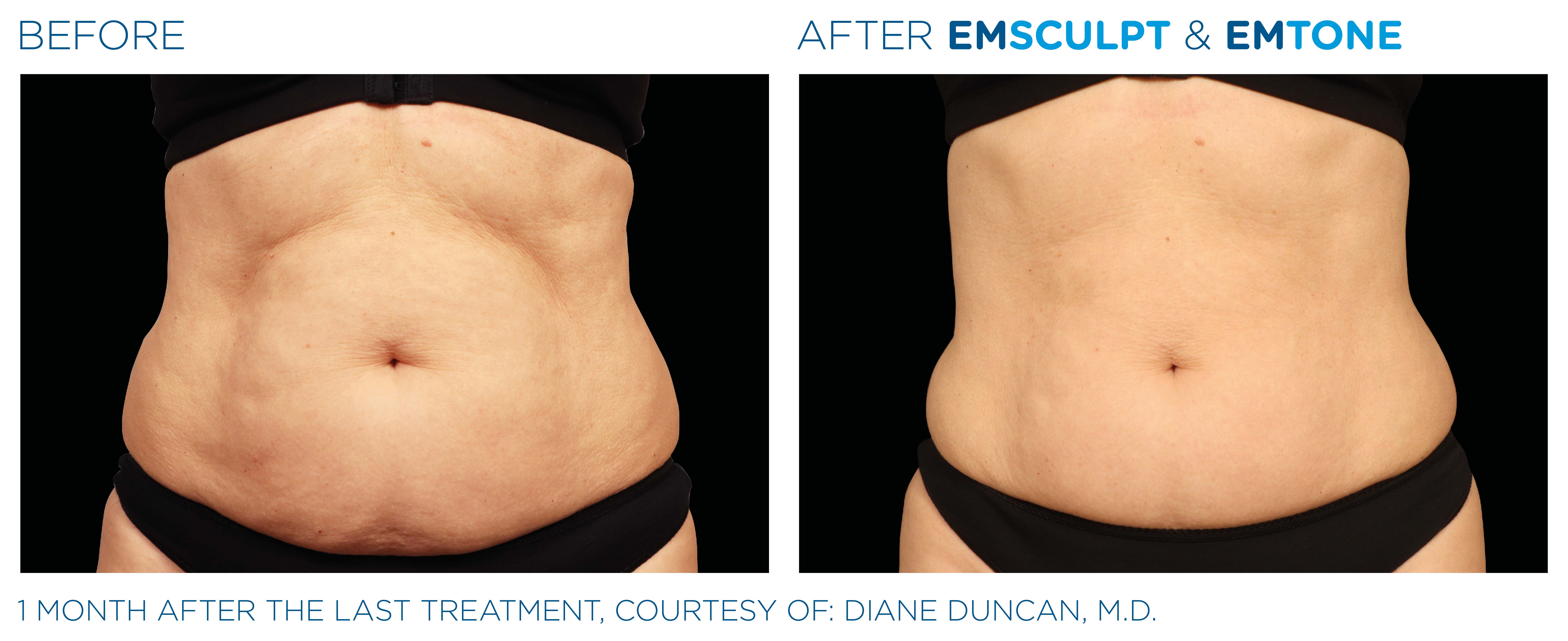 Emsculpt_Emtone_PIC_Ba-card-female-abdomen-024_ENUS100_1651185467