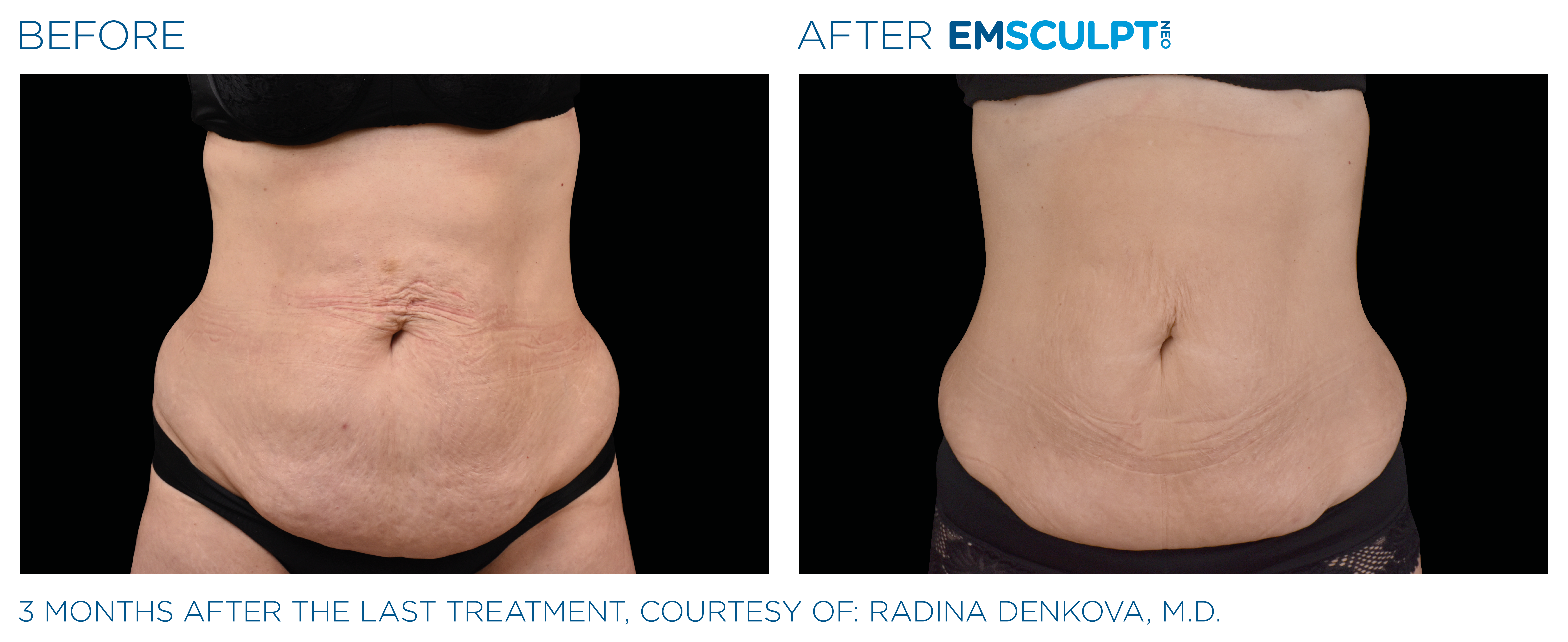 Best Brazilian Butt Lift Alternative, Emsculpt DC