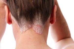 Psoriasis on scalp and hairline