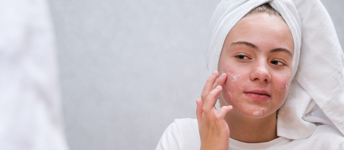 severe acne, acne treatment