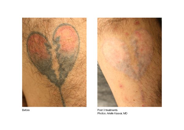 laser tattoo removal before and after example