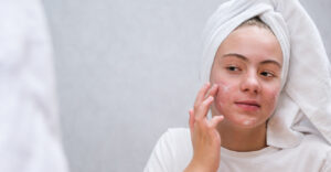 severe acne, acne treatment