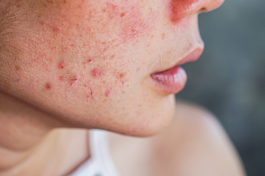 acne scarring, driggs dermatology