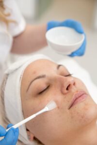 chemical peel Idaho Falls