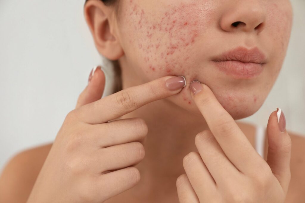 Acne Prone Skin, acne causing bacteria