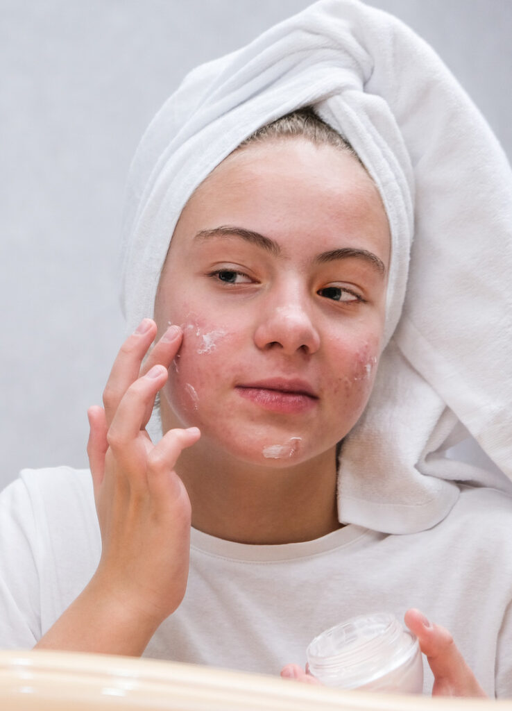 severe acne, acne treatment