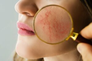 Rosacea Patients